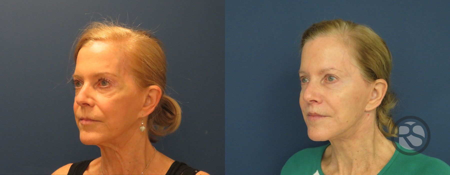 Before photo - Angle 2