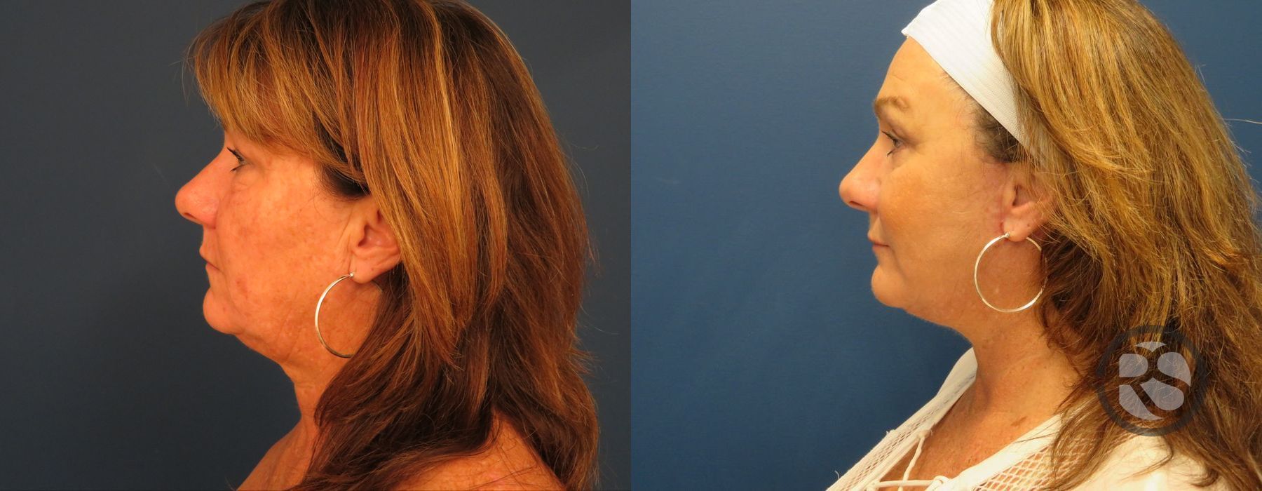 Before photo - Angle 5