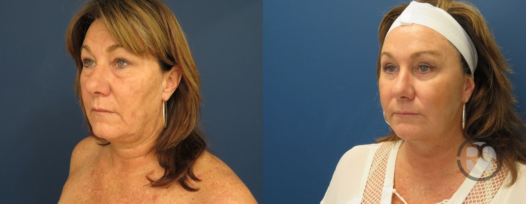 Before photo - Angle 4