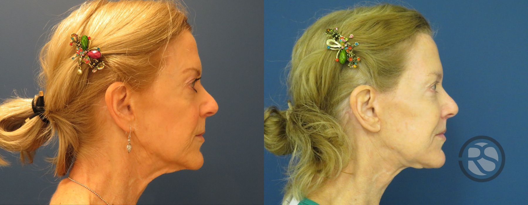 Before photo - Angle 5