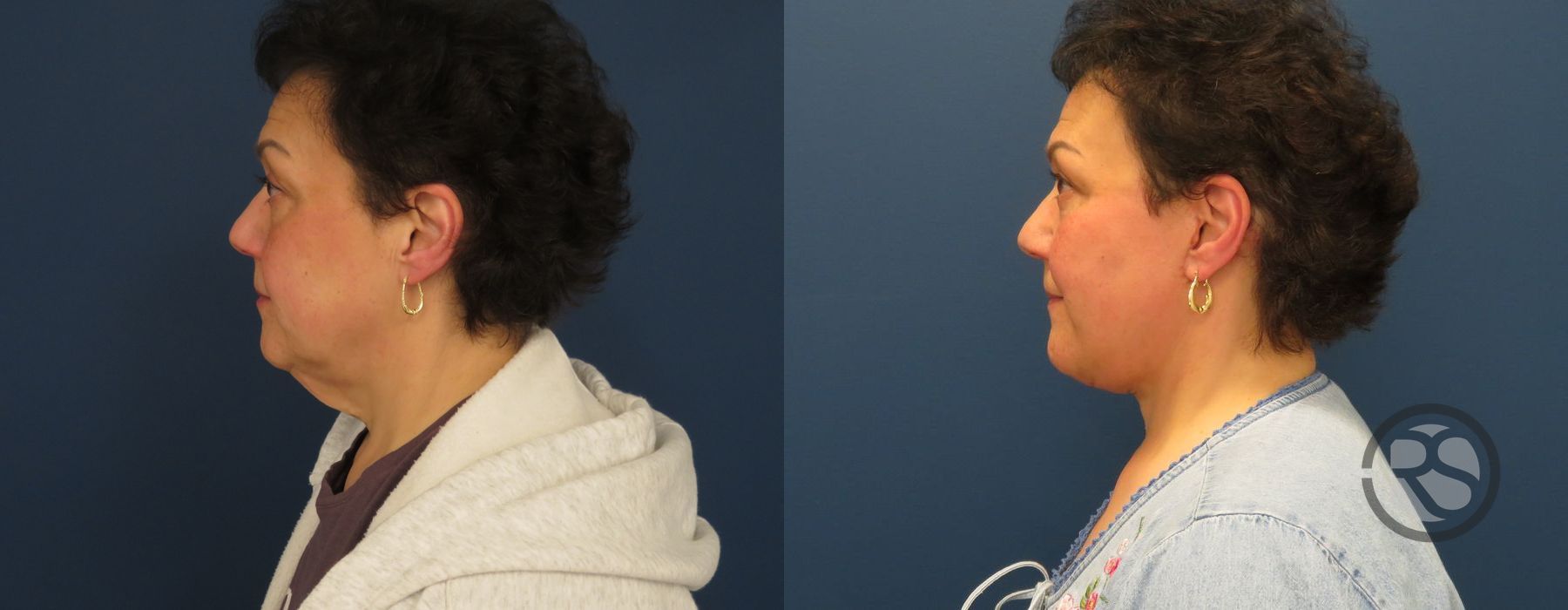 Before photo - Angle 5