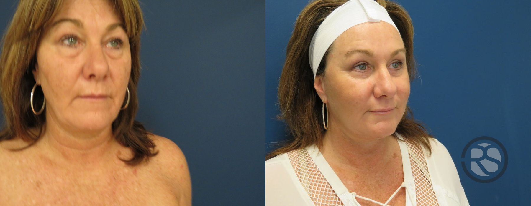 Before photo - Angle 2