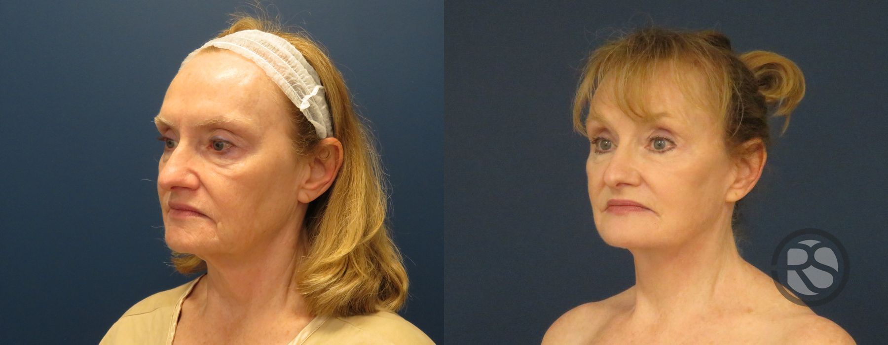 Before photo - Angle 4