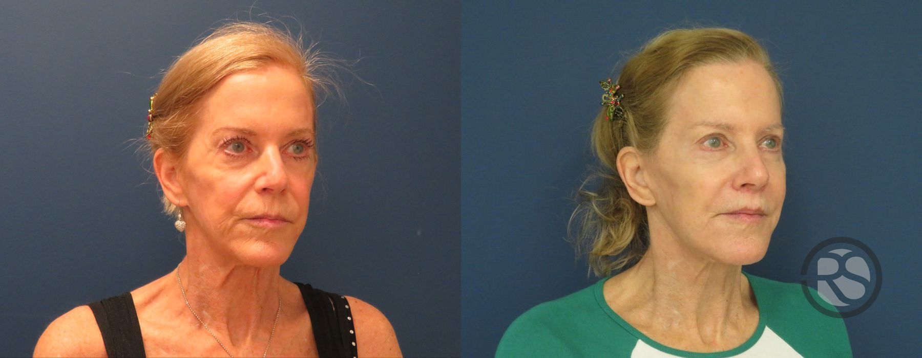 Before photo - Angle 4