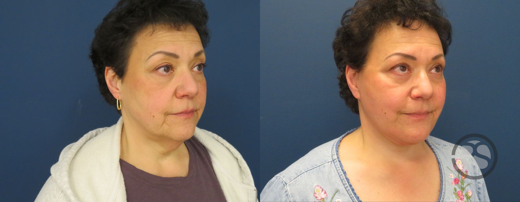 Before photo - Angle 2