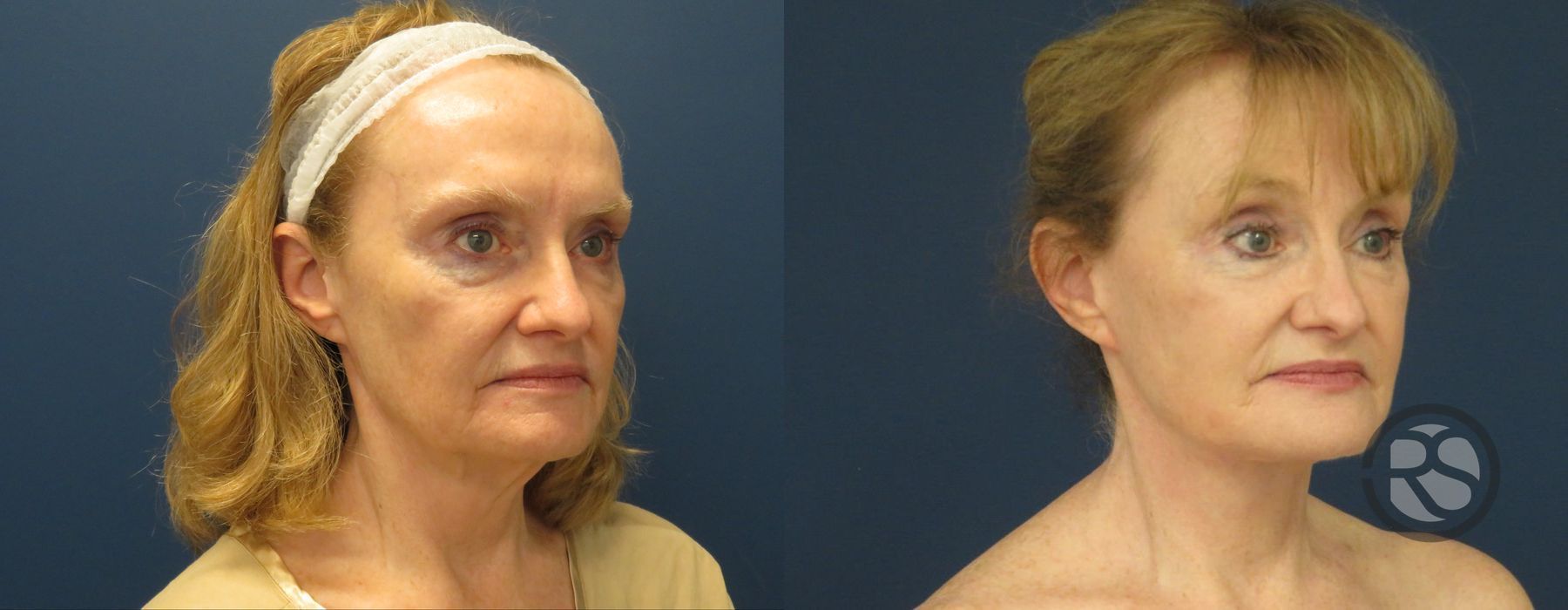 Before photo - Angle 2