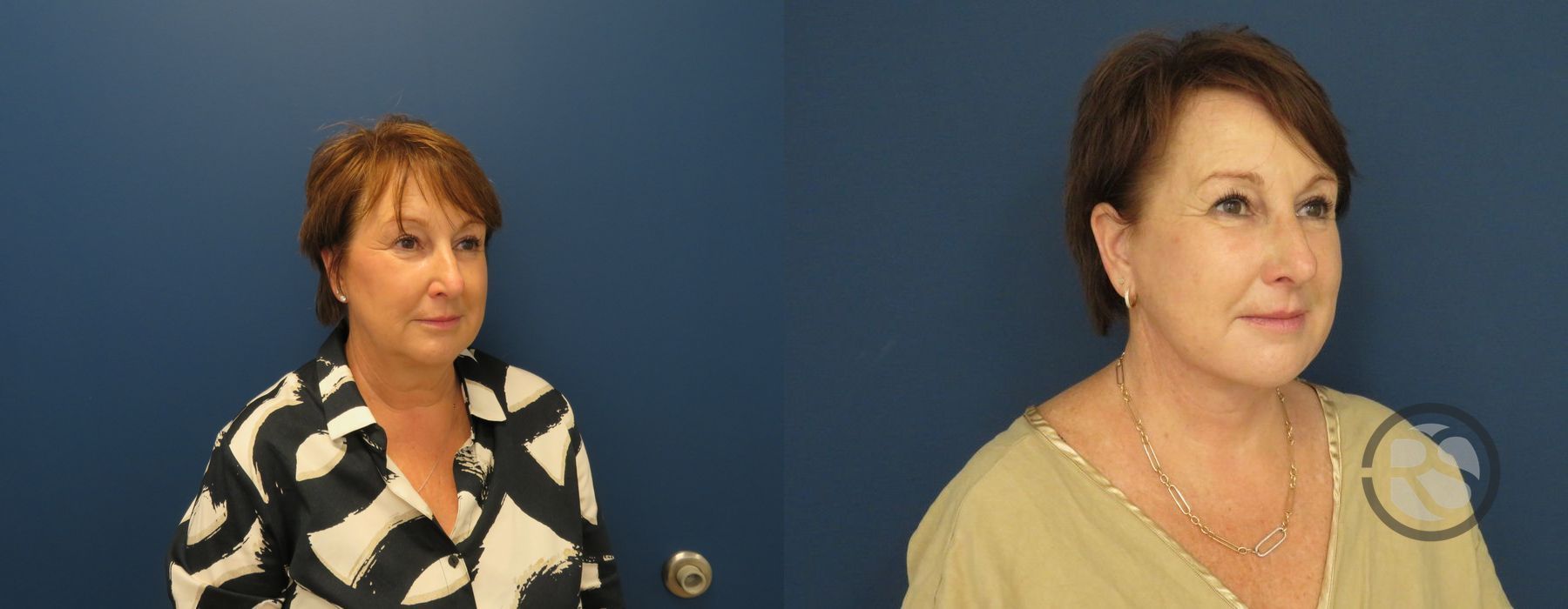 Before photo - Angle 3