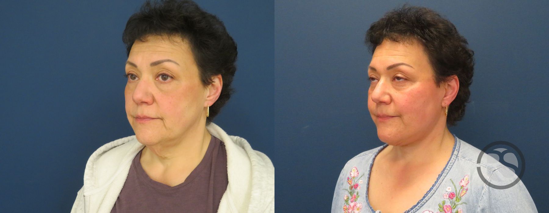 Before photo - Angle 4