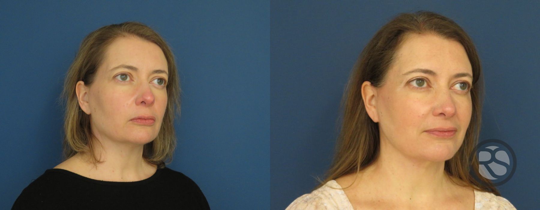 Before photo - Angle 2