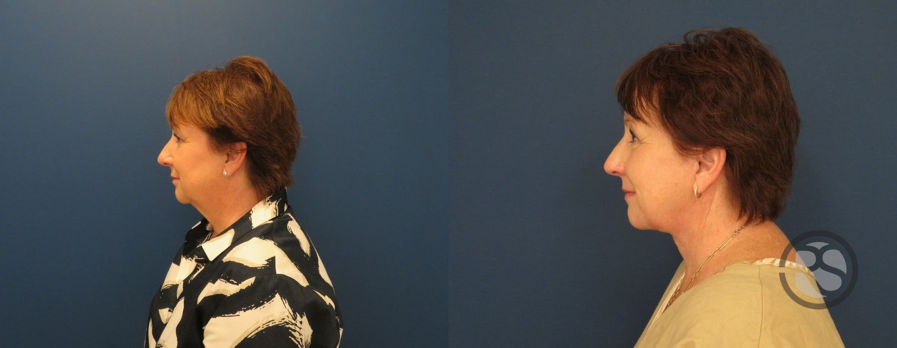 Before photo - Angle 4