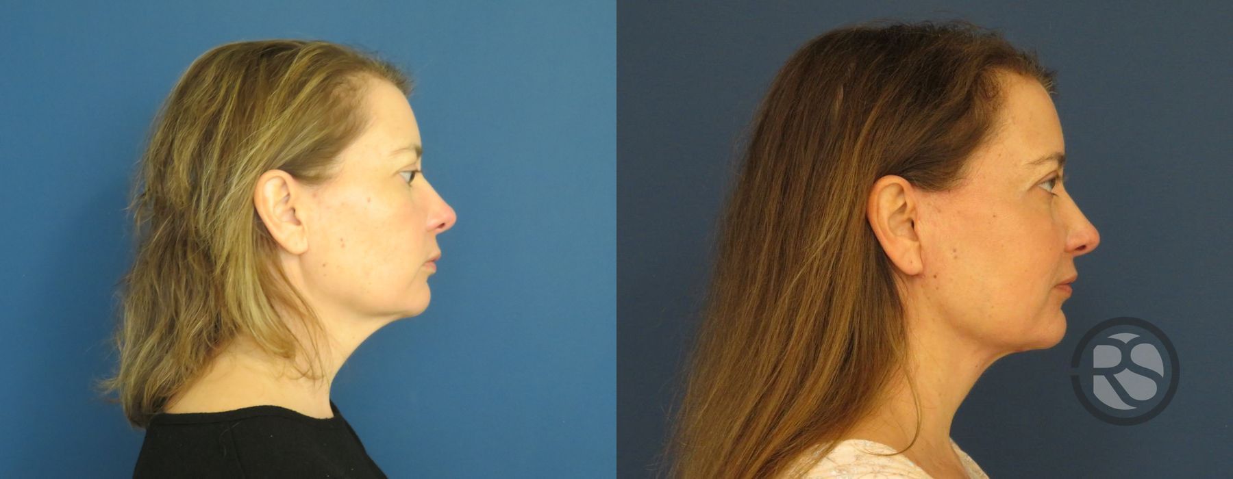 Before photo - Angle 3