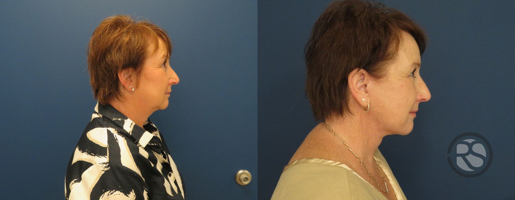 Before photo - Angle 2