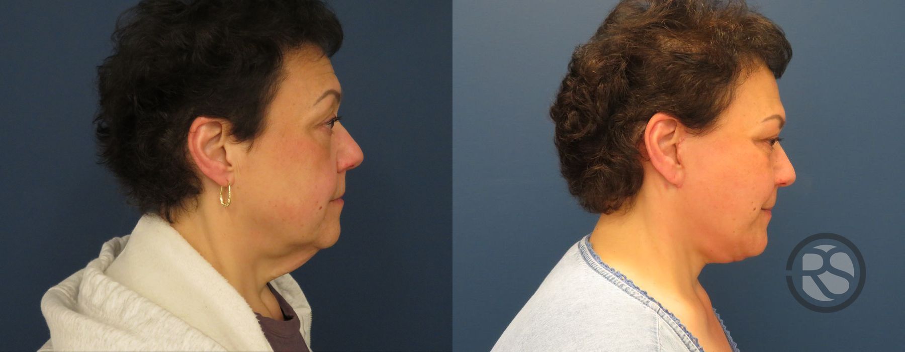 Before photo - Angle 3