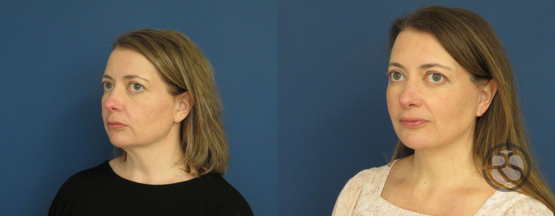 Before photo - Angle 4