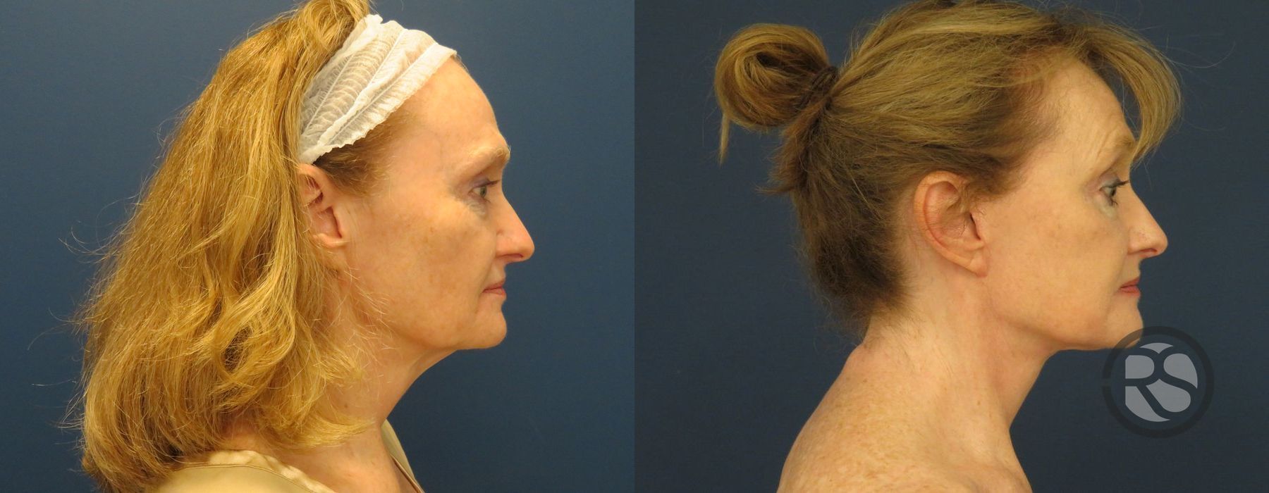 Before photo - Angle 3