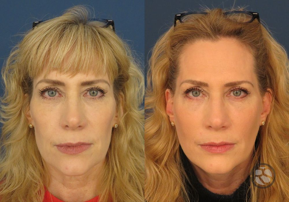 Facelift