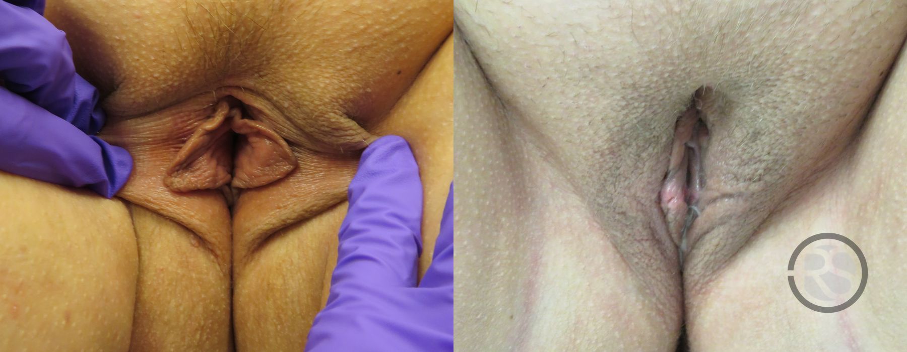 Labiaplasty