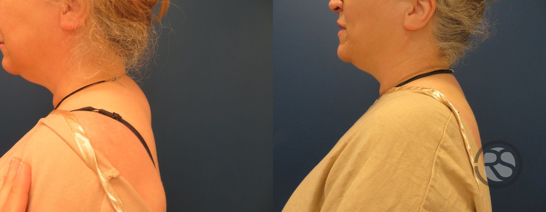 Before photo - Angle 2