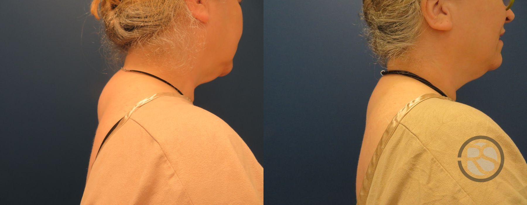 Before photo - Angle 3