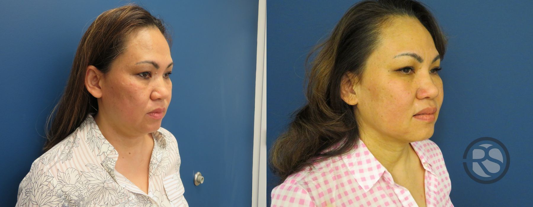 Before photo - Angle 2