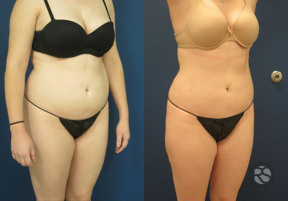 Before photo - Angle 2