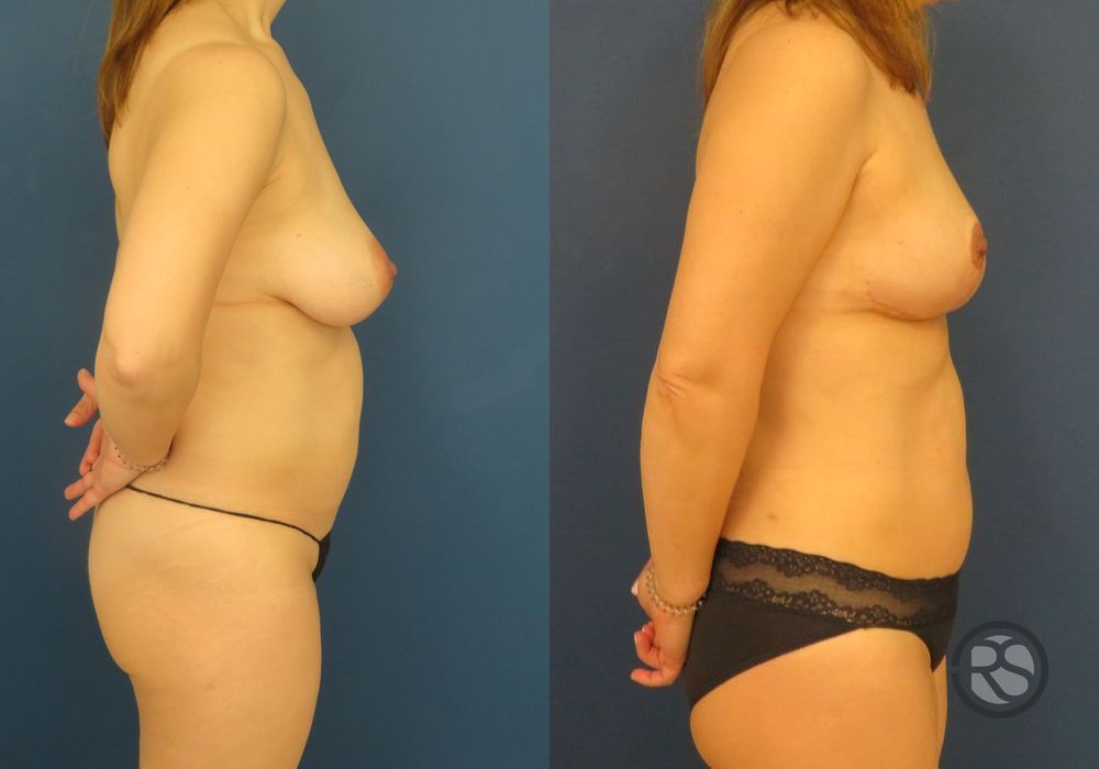 Before photo - Angle 3