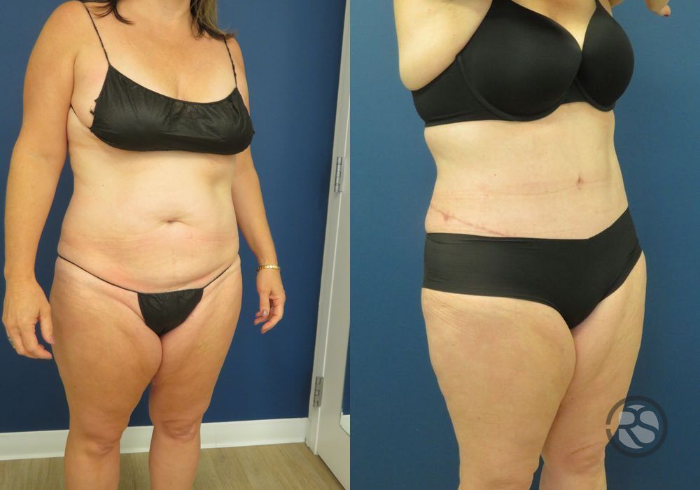 Before photo - Angle 2