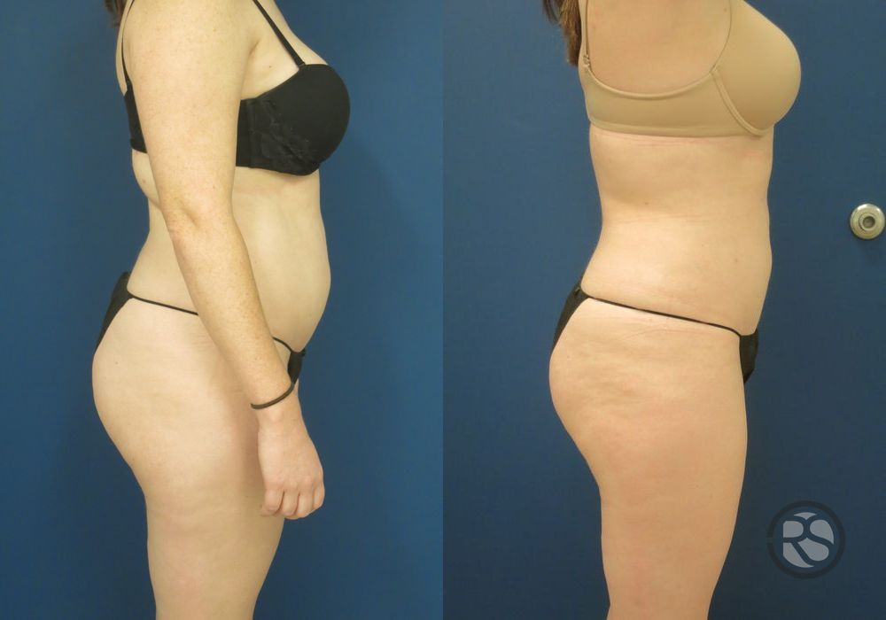 Before photo - Angle 3