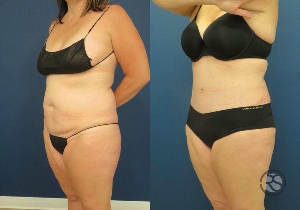 Before photo - Angle 4