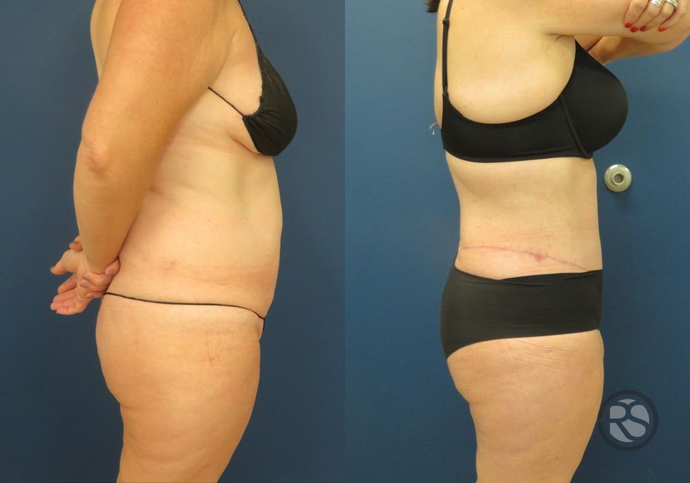 Before photo - Angle 3