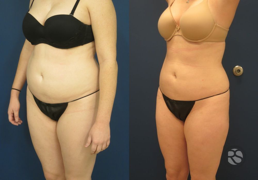 Before photo - Angle 4