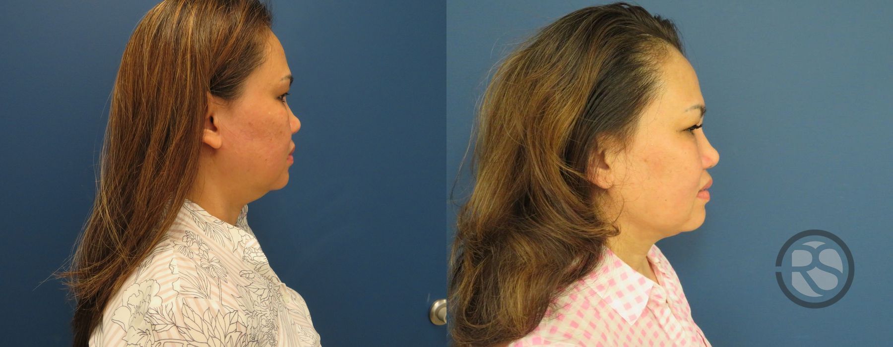 Before photo - Angle 3