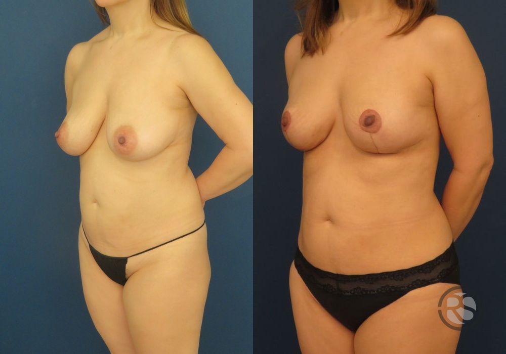 Before photo - Angle 4