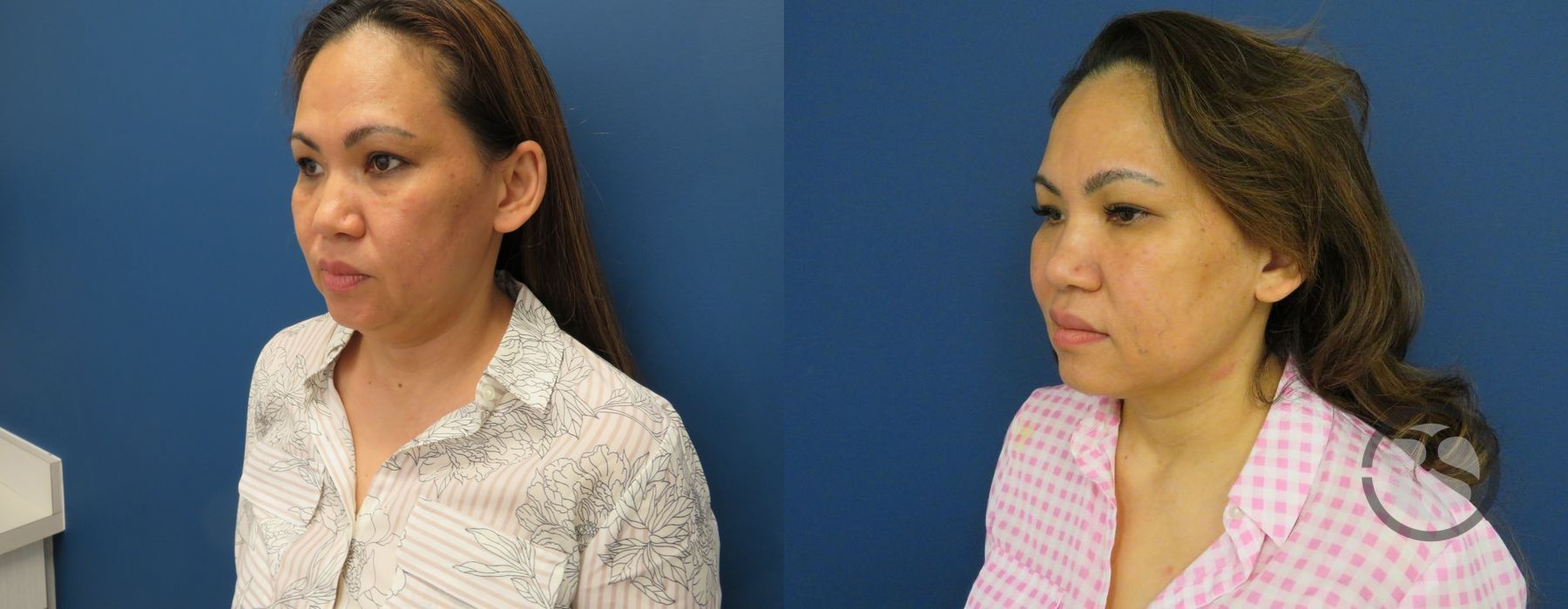 Before photo - Angle 4