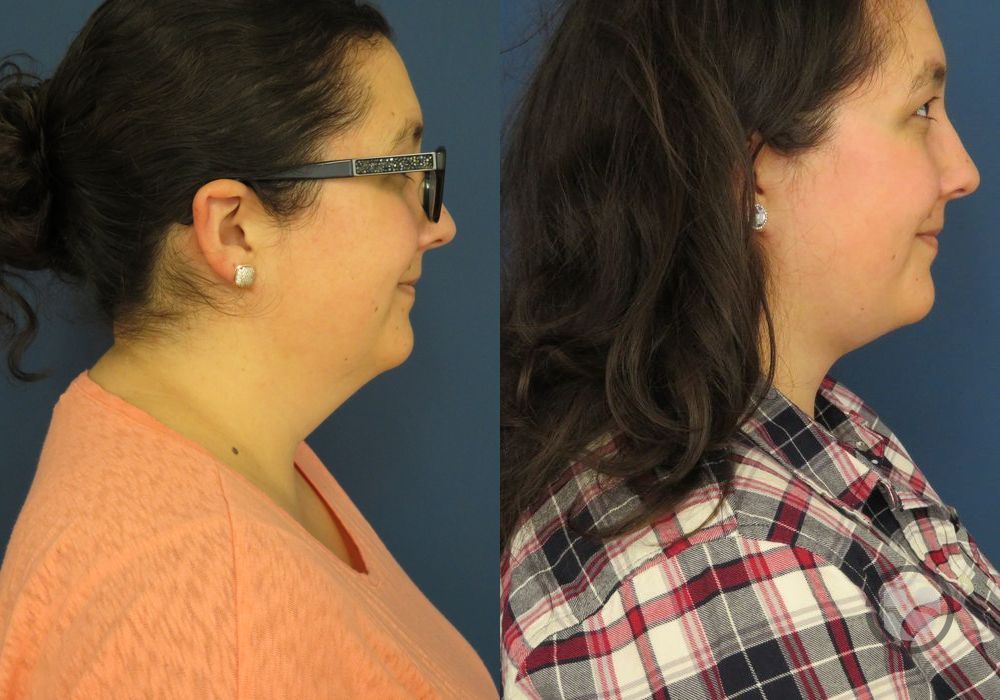 Before photo - Angle 3