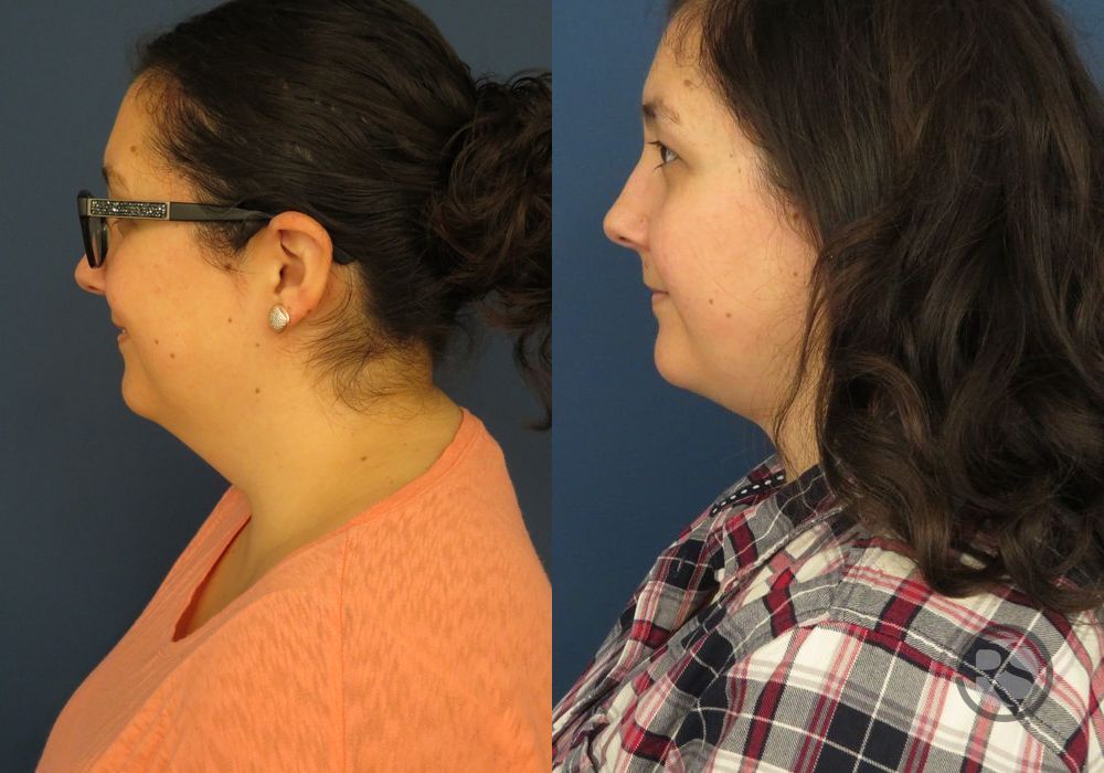 Before photo - Angle 5