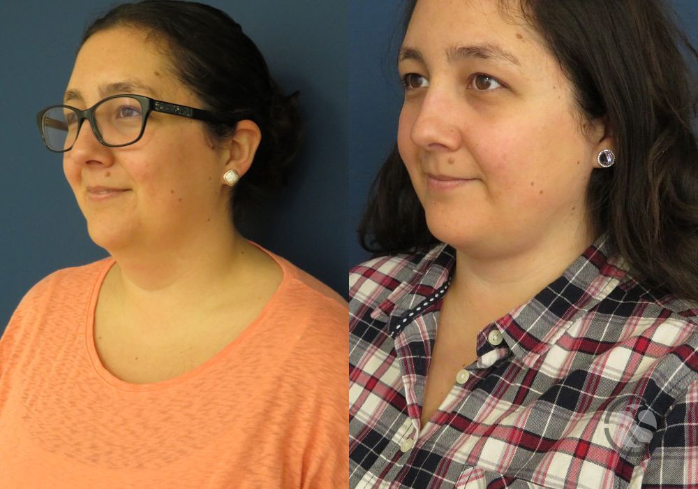 Before photo - Angle 4