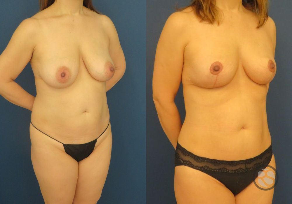 Before photo - Angle 2