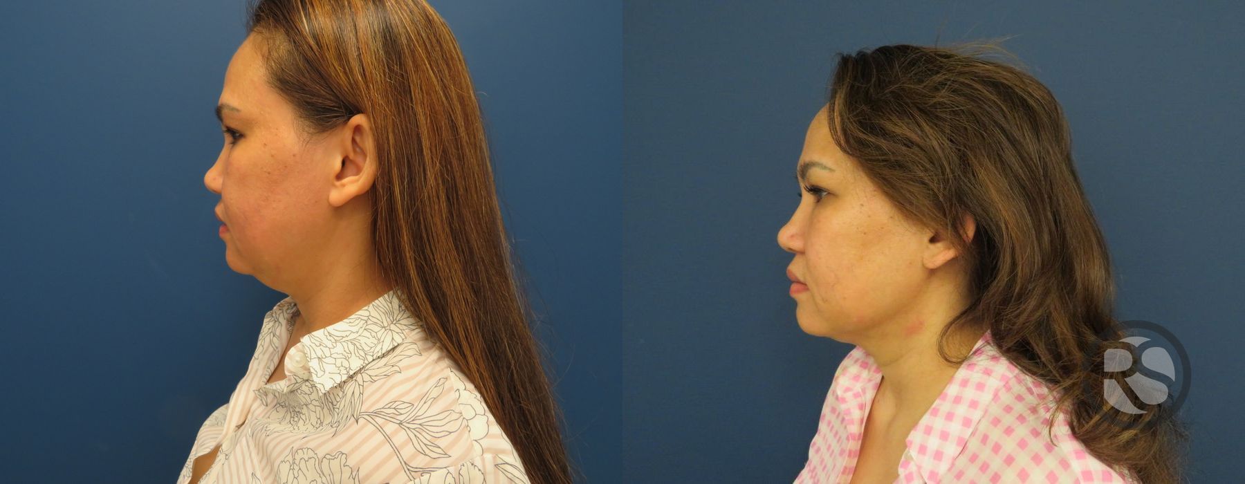 Before photo - Angle 5