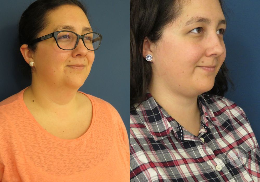 Before photo - Angle 2