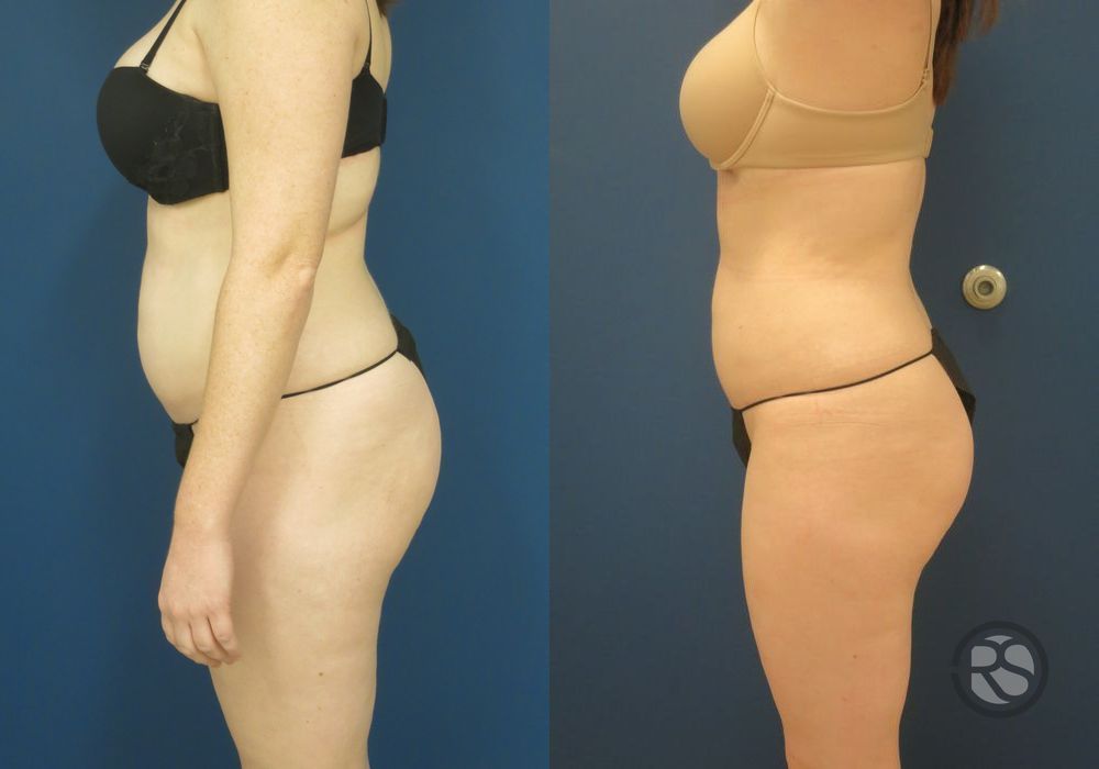 Before photo - Angle 5