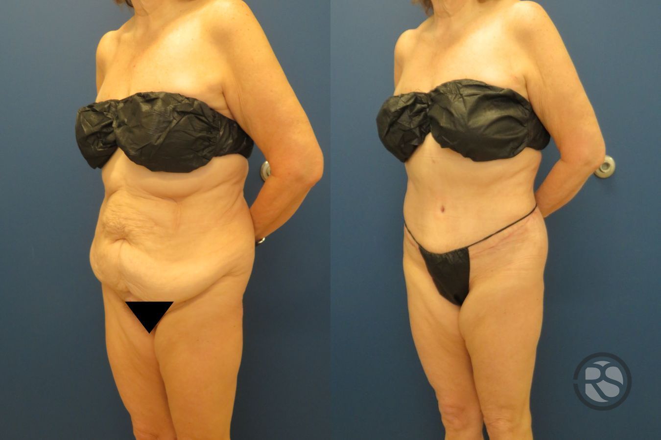 Before and after Liposuction case 43475 - Angle 4
