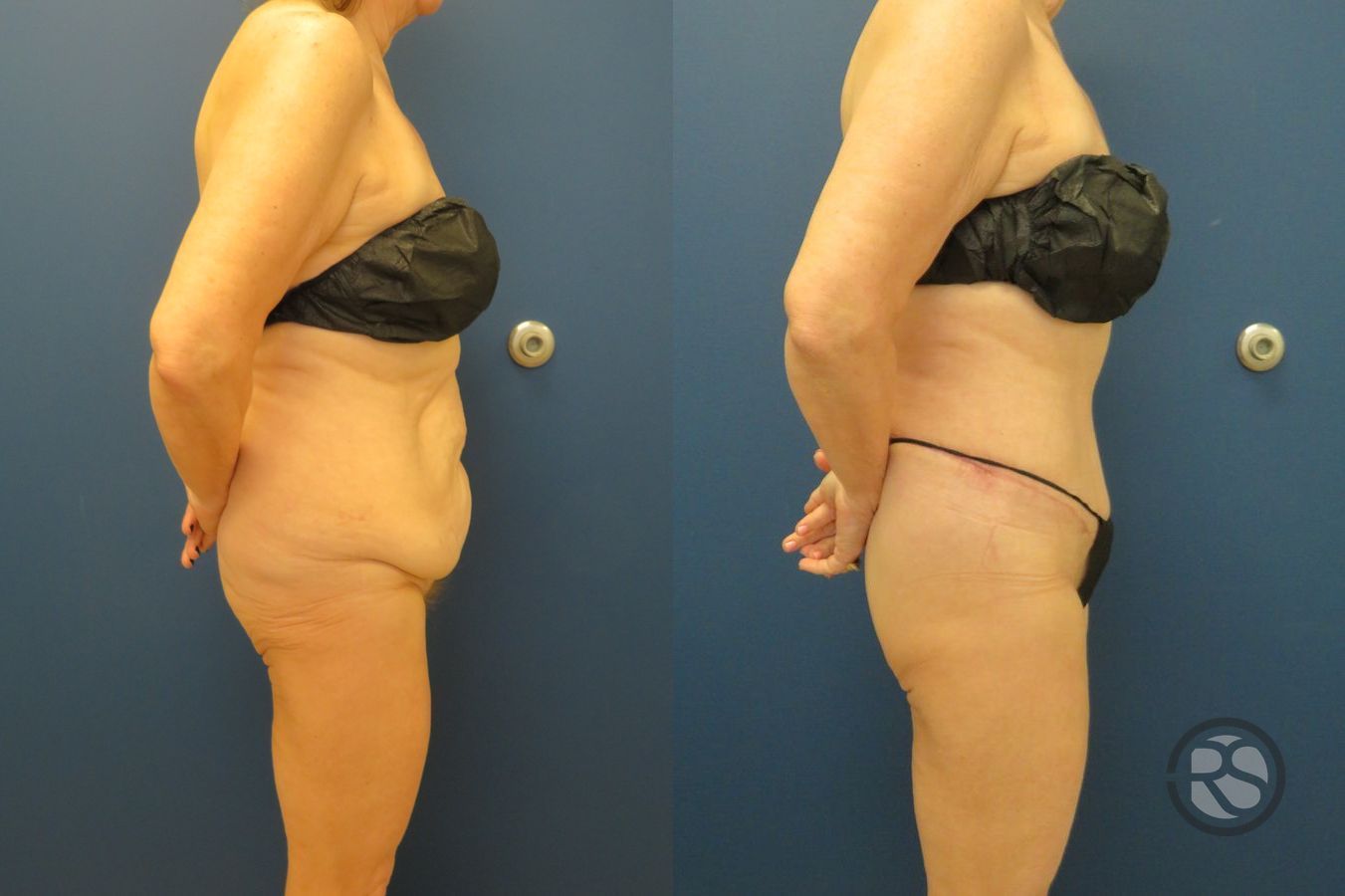 Before and after Liposuction case 43475 - Angle 3