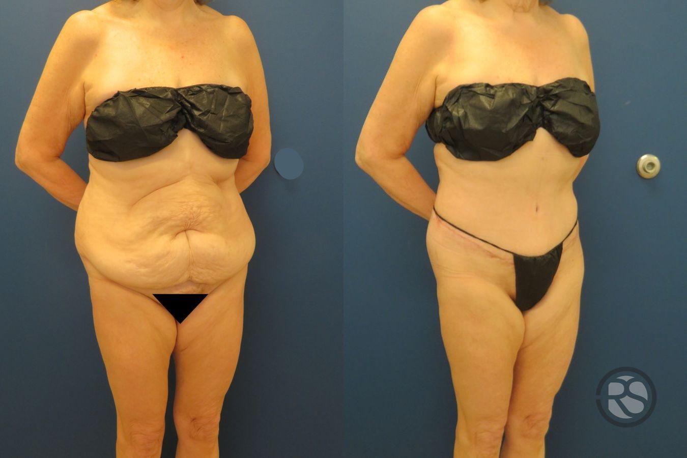 Before and after Liposuction case 43475 - Angle 2