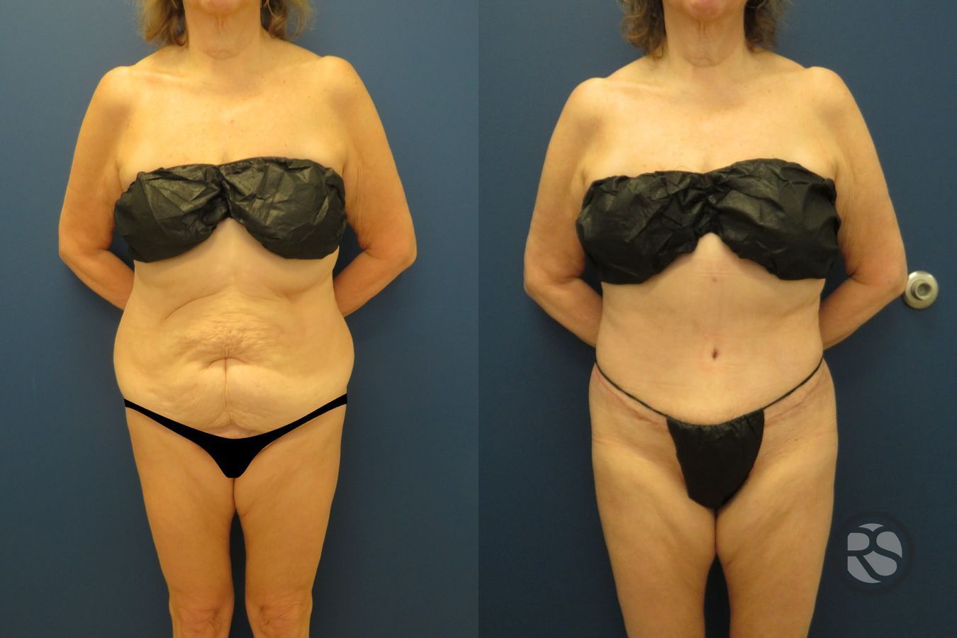Liposuction