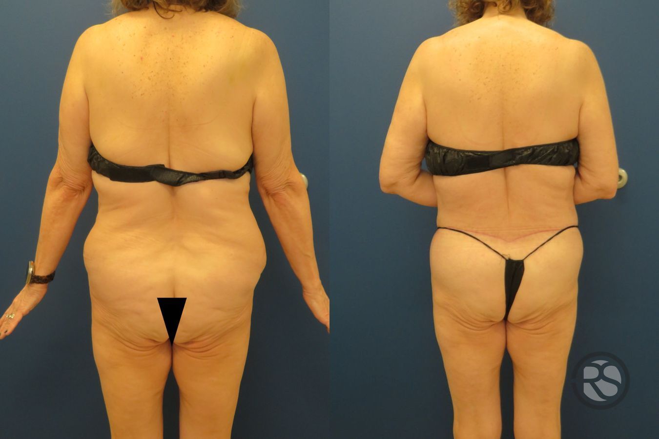 Before and after Liposuction case 43475 - Angle 6