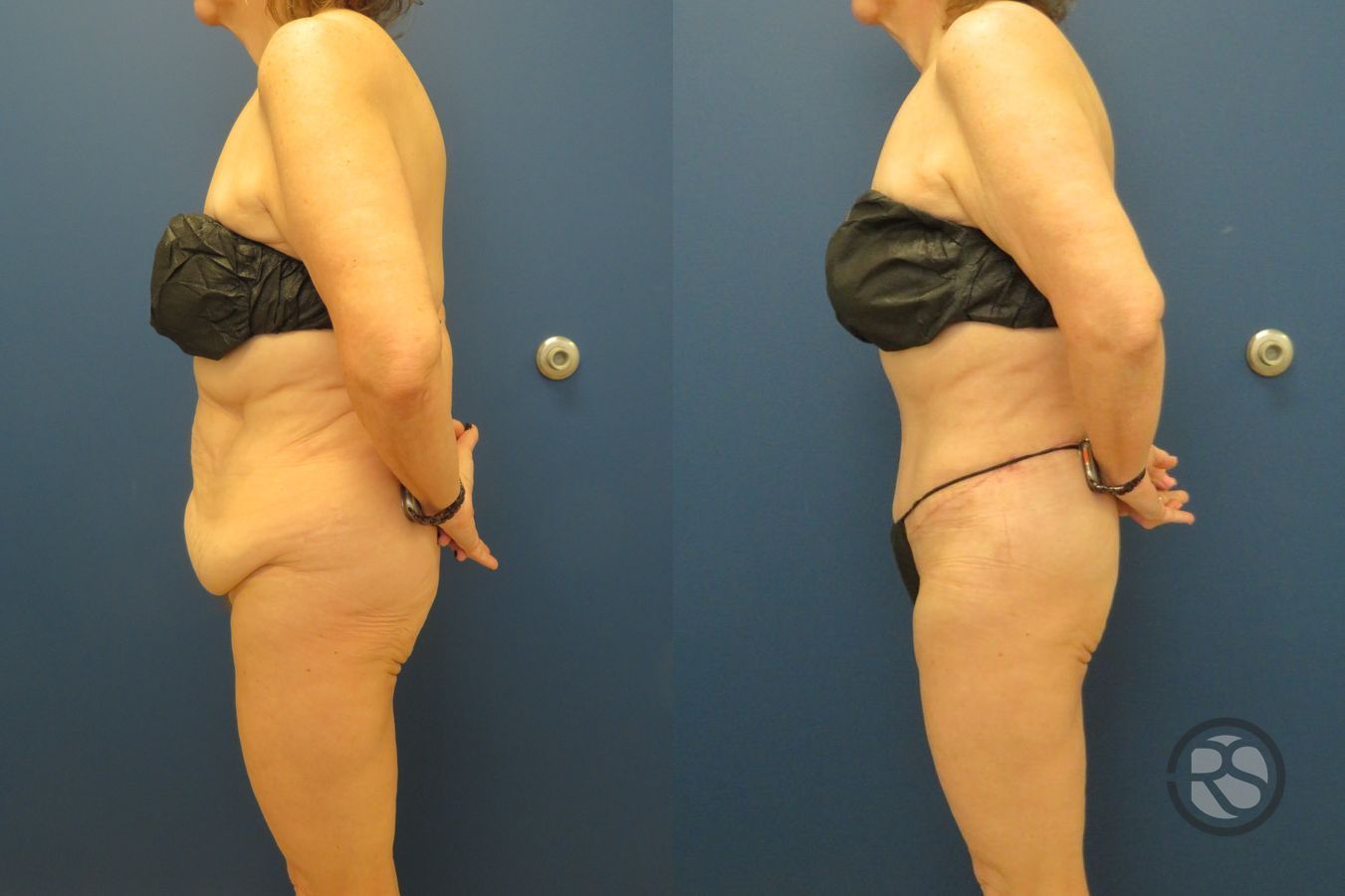 Before and after Liposuction case 43475 - Angle 5