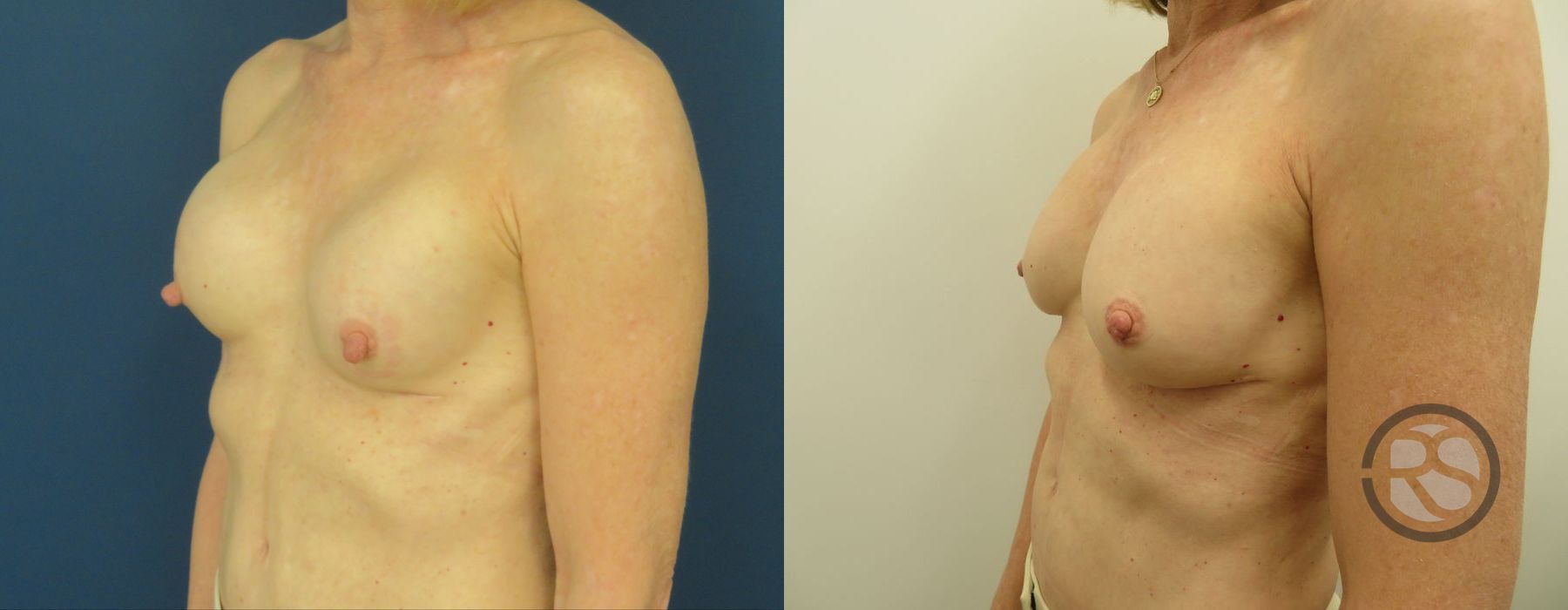 Before photo - Angle 4