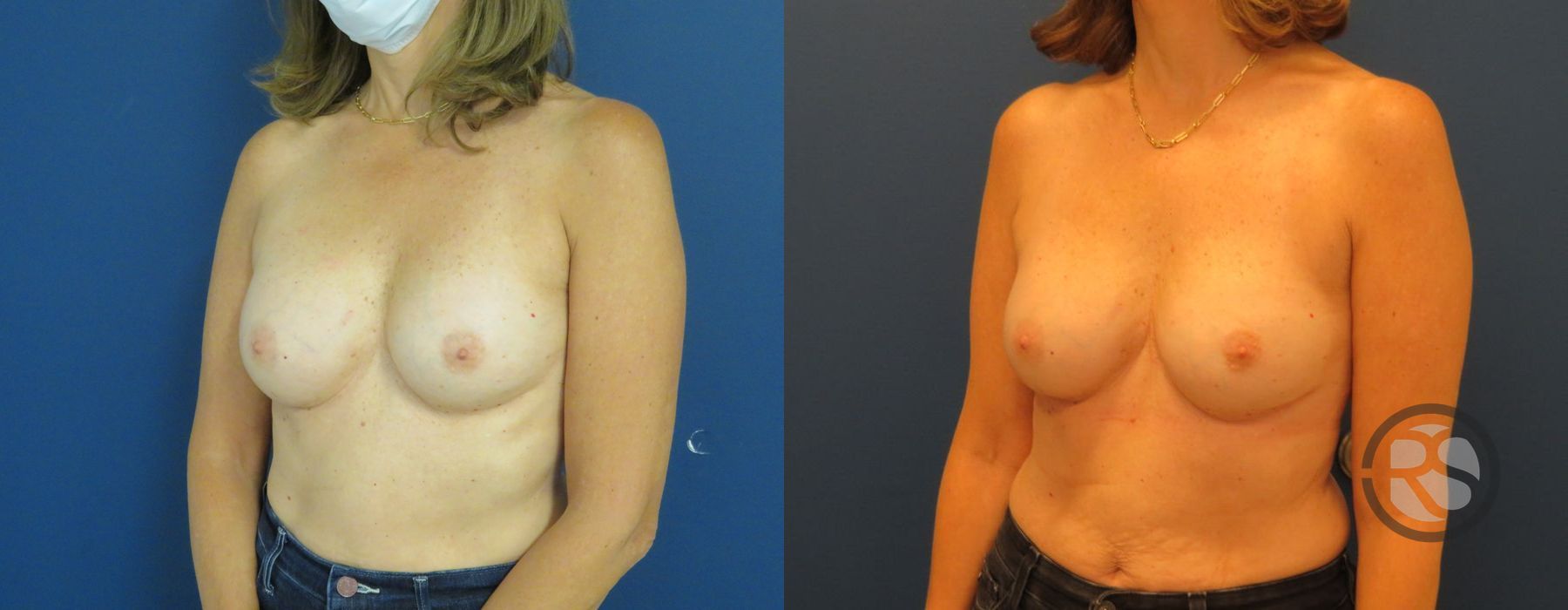 Before photo - Angle 4