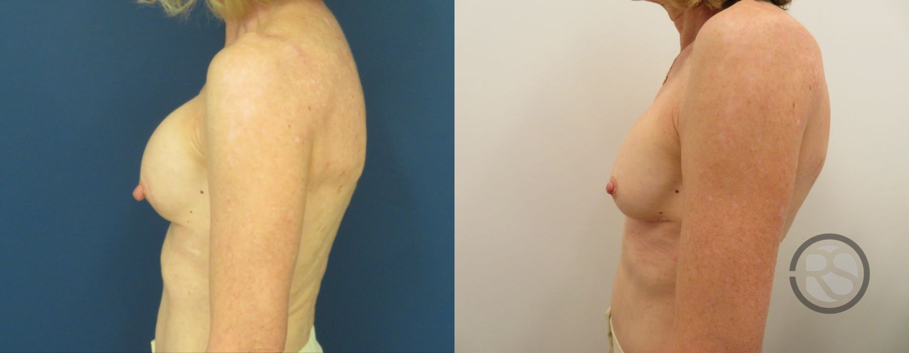 Before photo - Angle 5